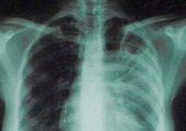 Приморские депутаты обеспокоены ситуацией по заболеваемости туберкулезом