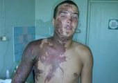 Изувеченный серной кислотой солдат-срочник попал в реанимацию в Приморье